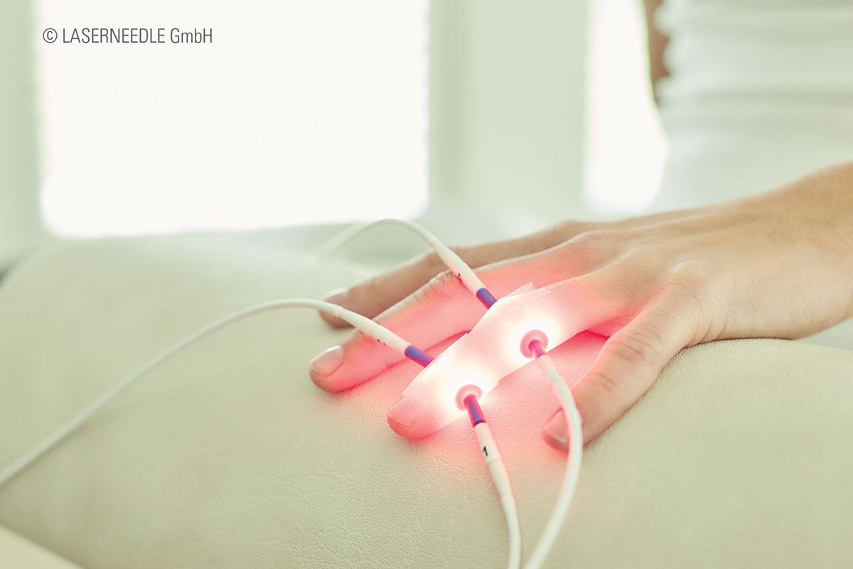 Lasertherapie an den Fingergelenken