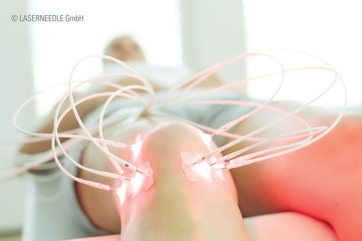 Laserbehandlung am Knie mit der Laserneedle-Technologie