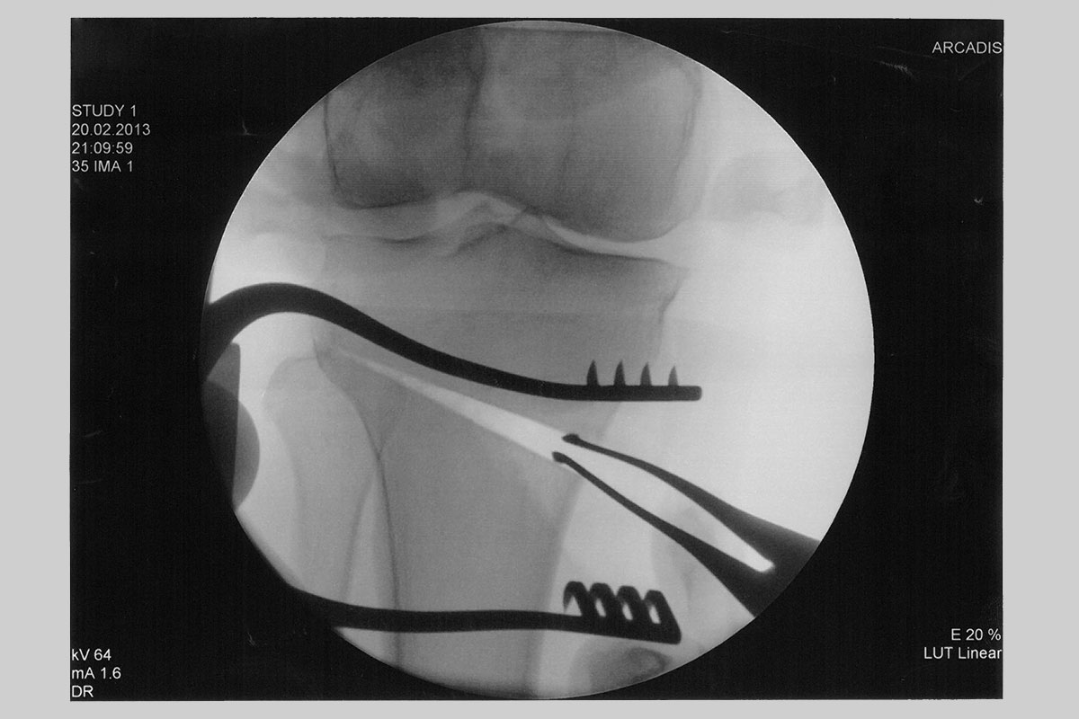 Umstellungsosteotomie Röntgenaufnahme