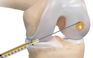 Grafik AutoCart™ Methode bei Knorpelschäden Schritt 16