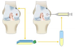 Grafik zur Knorpeltransplantation im Knorpelzentrum Wien