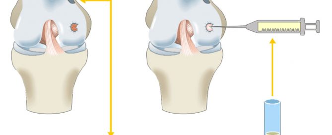 Grafik zur Knorpeltransplantation im Knorpelzentrum Wien