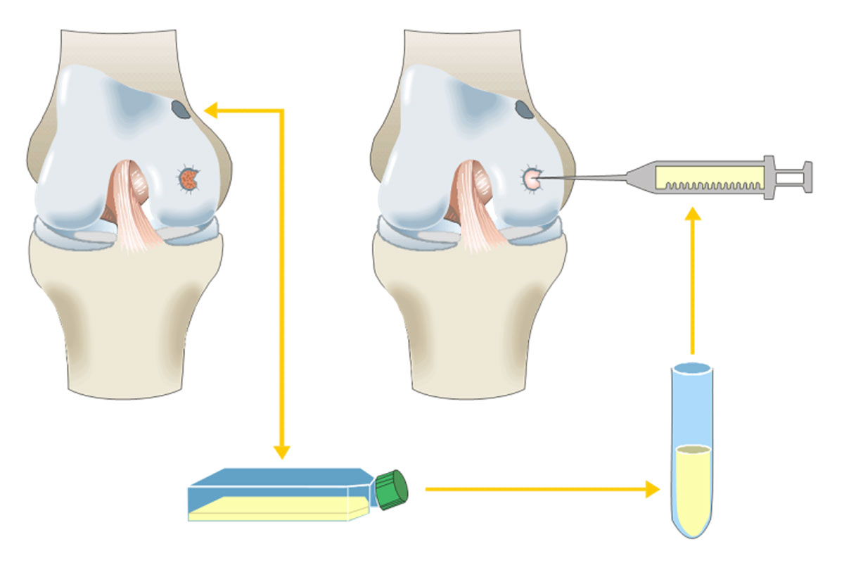 Grafik zur Knorpeltransplantation im Knorpelzentrum Wien