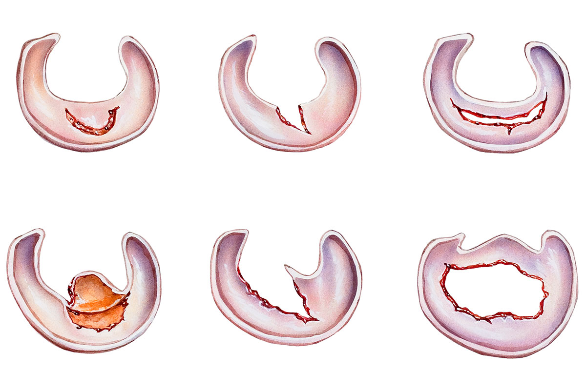 Grafik Meniskusriss / Meniskusruptur