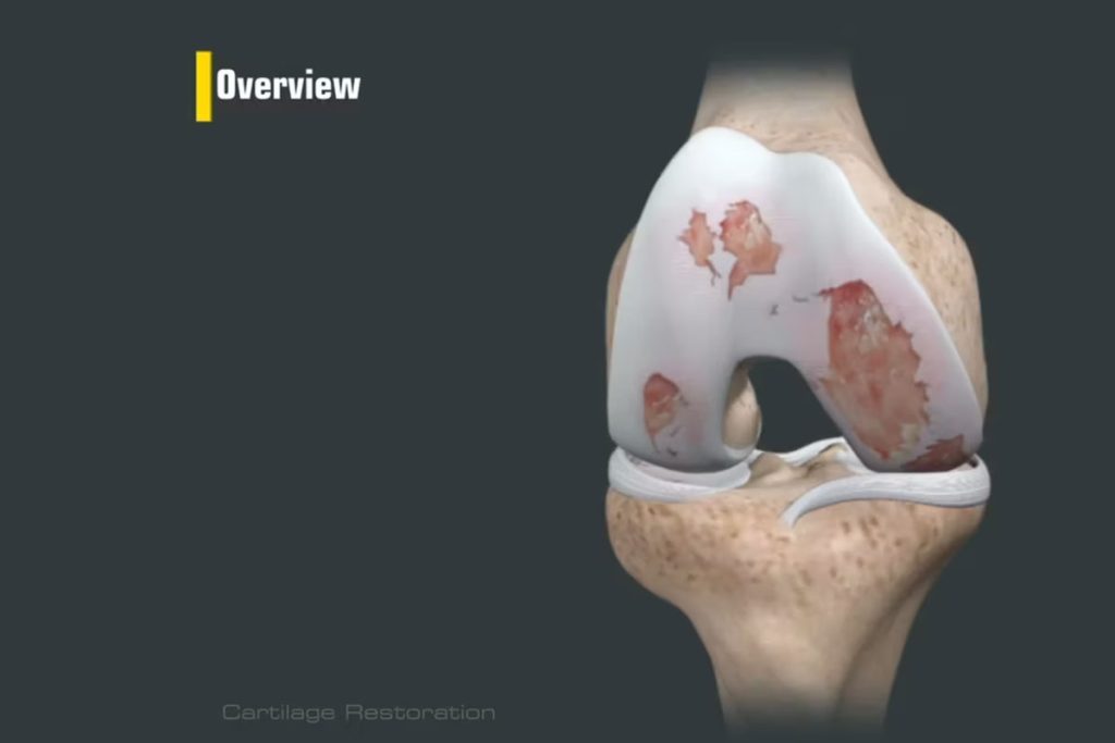 Knorpelreparatur und Knorpelwiederherstellung