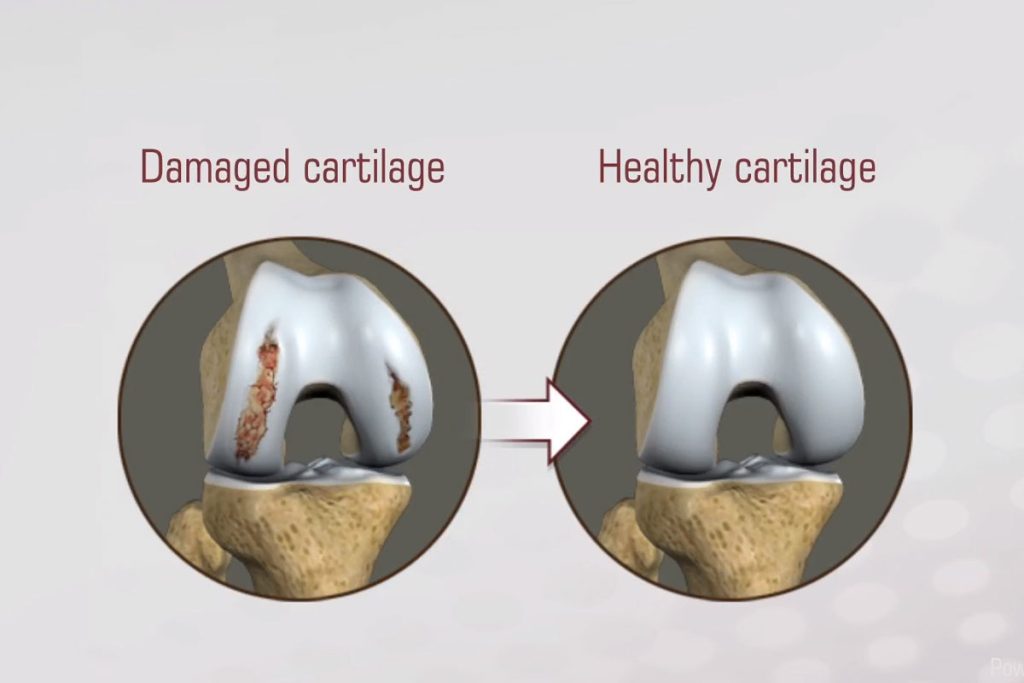 Knorpeltransplantation