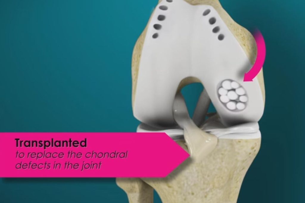 Osteochondrale Autografts