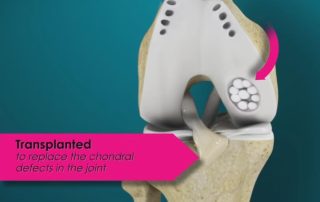 Osteochondrale Autografts